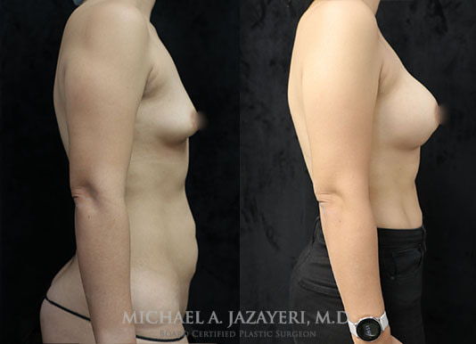 breast augmentation before and after right