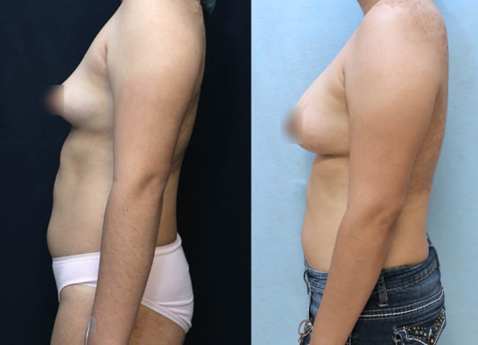 Breast Augmentation Before & After Photos