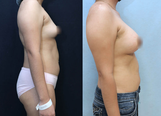 Breast Augmentation Before & After Photos