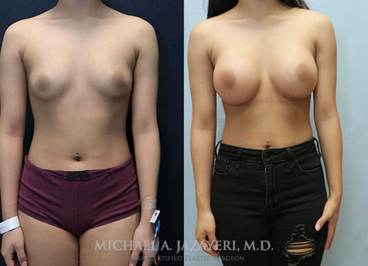 Breast Augmentation before and after front