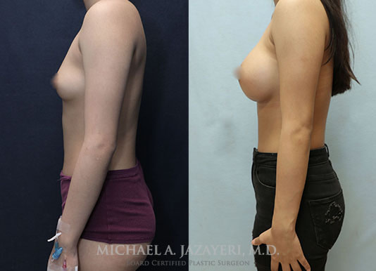 Breast Augmentation before and after left