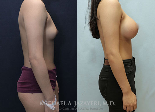 Breast Augmentation before and after right