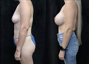 Breast implant before and after