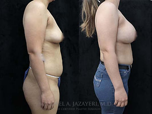 bilateral breast augmentation before and after
