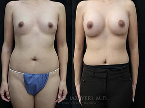 breast augmentation before and after right