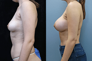 breast augmentation before and after photos - left