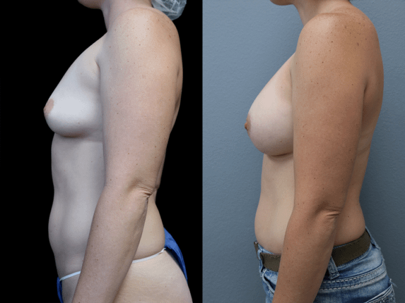 Breast Augmentation Before & After Photos Left Side