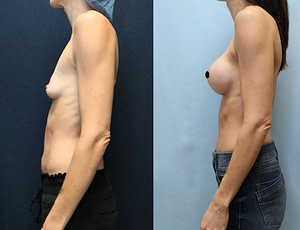 breast augmentation before and after left side