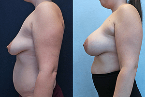 breast augmentation before and after photos - left