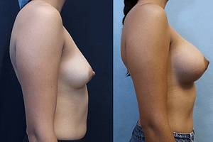 breast augmentation before and after photos - right