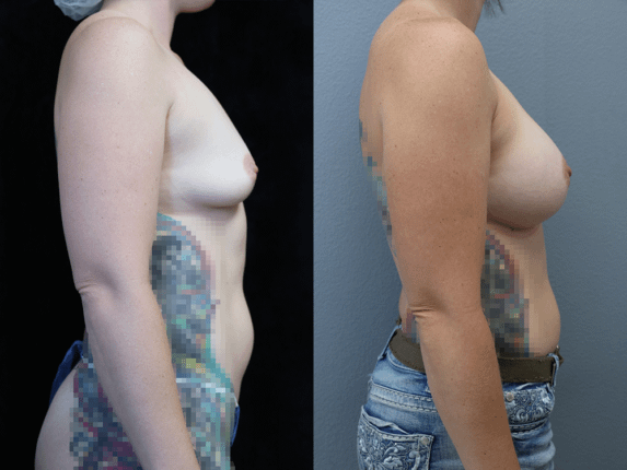 Breast Augmentation Before & After Photos Right Side