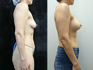 breast augmentation before and after photos - right