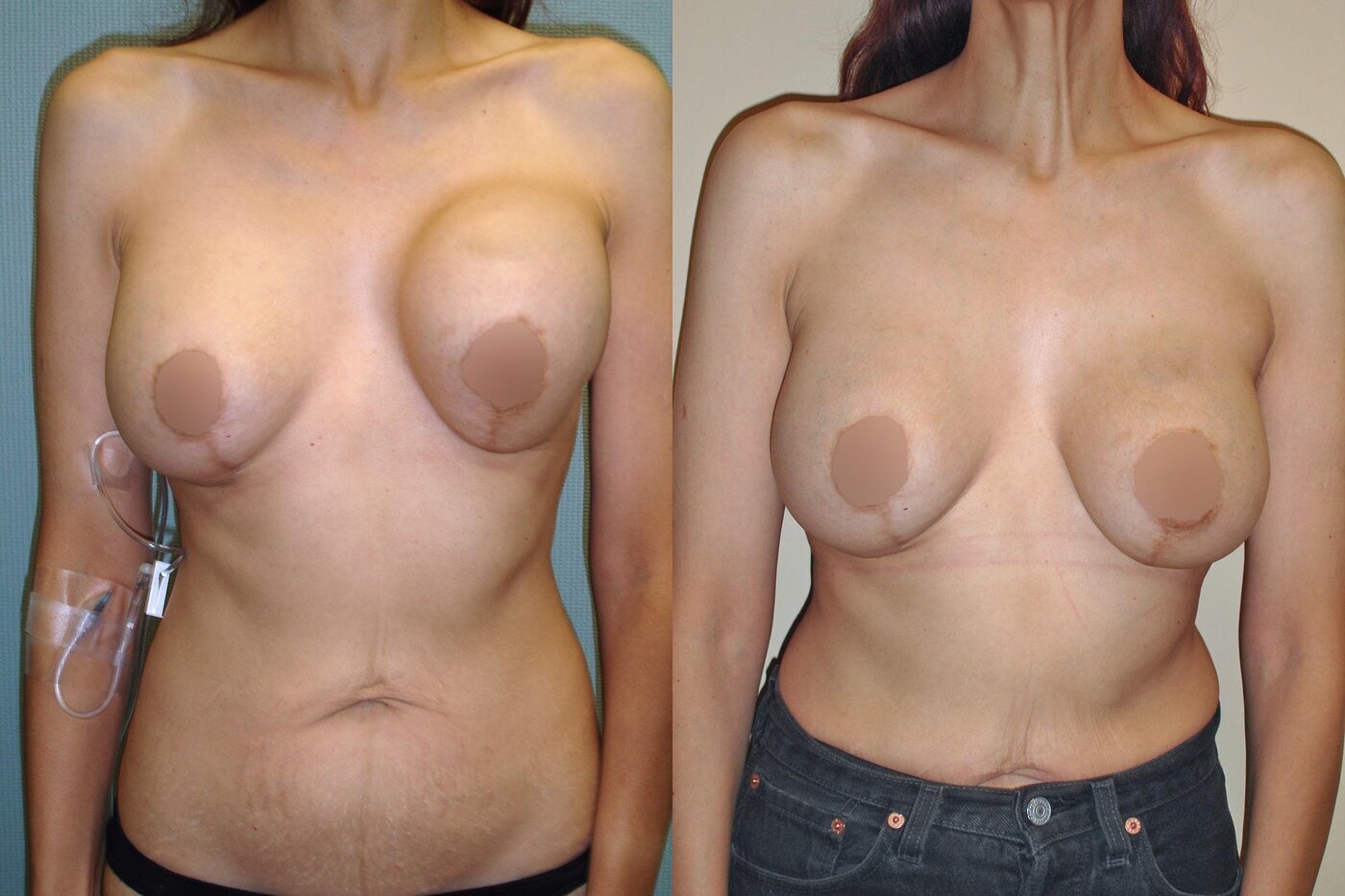 Breast Revision Before & After Photos