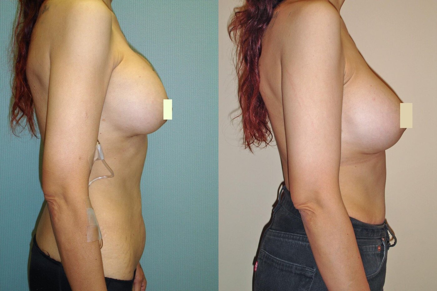 Breast Revision Before & After Photos