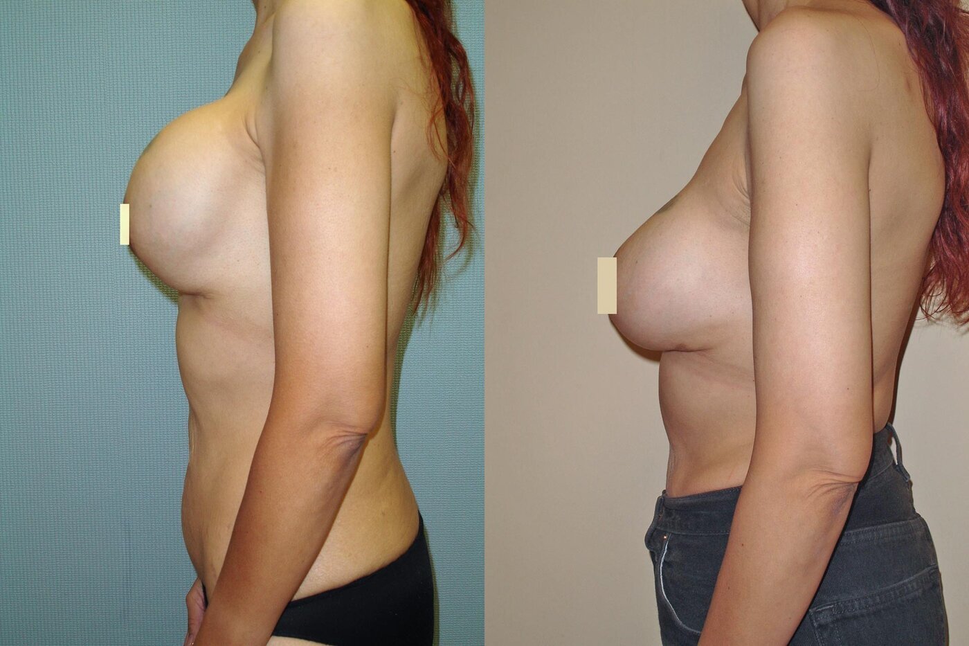 Breast Revision Before & After Photos