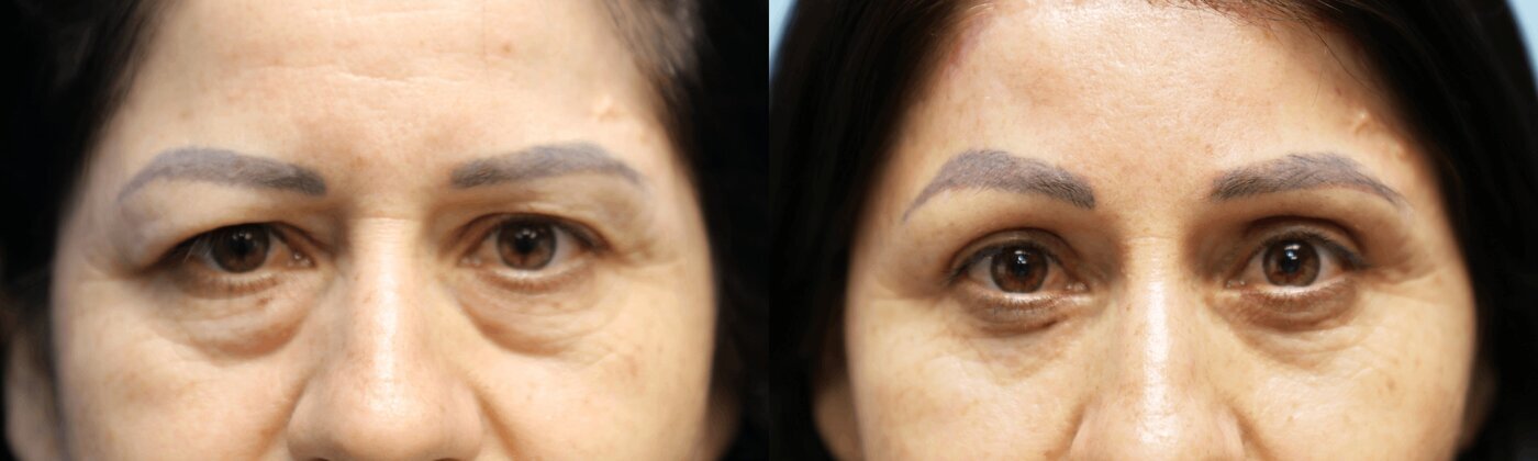 Brow Lift Before & After Photos