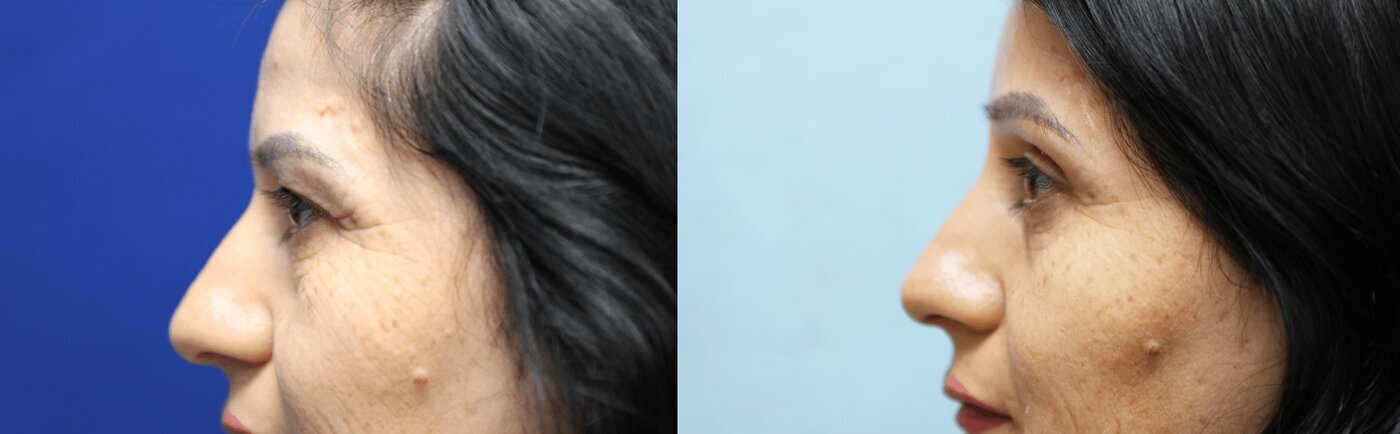 Brow Lift Before & After Photos