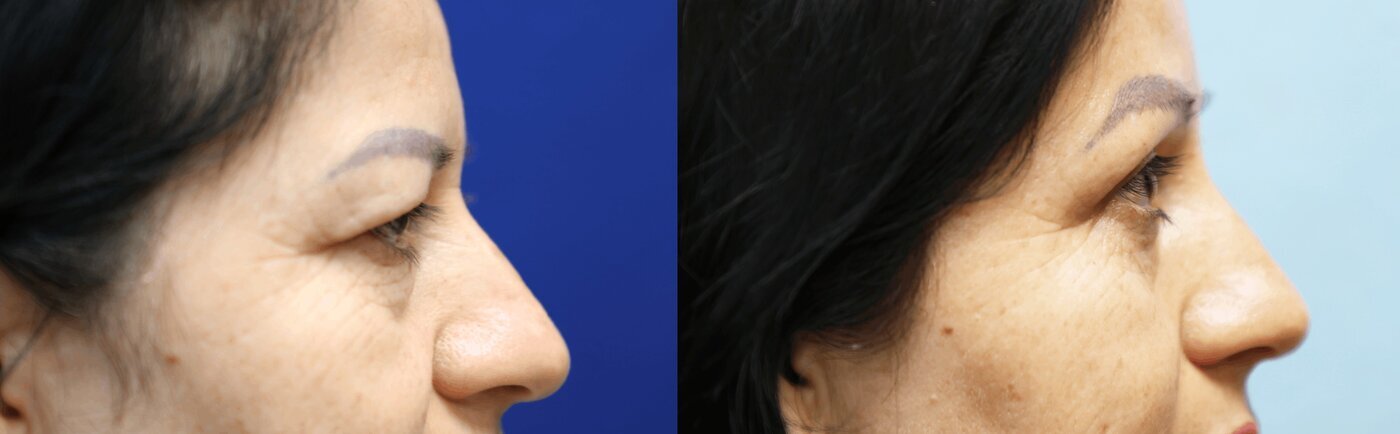 Brow Lift Before & After Photos