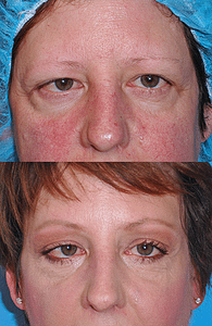 Brow Lift Before & After Photos