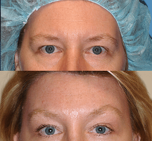 Brow Lift Before & After Photos