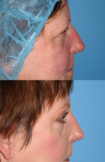 Brow Lift Before & After Photos