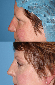 Brow Lift Before & After Photos