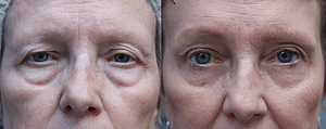 Brow Lift Before & After Photos