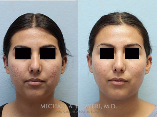 Buccal Fat Removal Before & After Photos