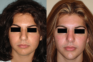 Chin Augmentation Before & After Photos