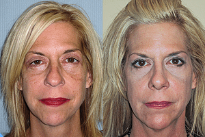Chin Augmentation Before & After Photos