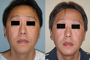 Chin Augmentation Before & After Photos
