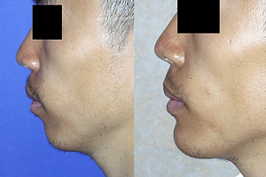 Chin Augmentation Before & After Photos