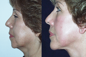 Chin Augmentation Before & After Photos Left