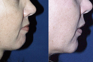 Chin Augmentation Before & After Photos