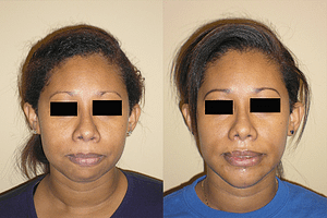 Chin Augmentation Before & After Photos