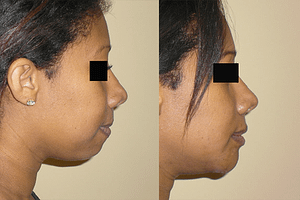 Chin Augmentation Before & After Photos Right