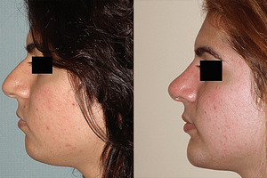 Chin Augmentation Before & After Photos