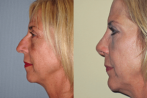 Chin Augmentation Before & After Photos