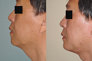 Chin Augmentation Before & After Photos