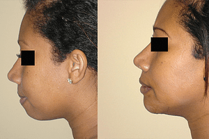 Chin Augmentation Before & After Photos Left