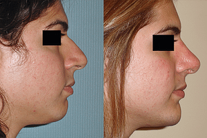 Chin Augmentation Before & After Photos