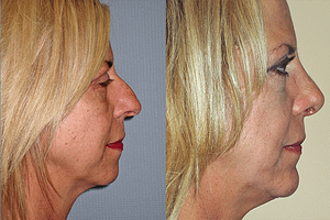 Chin Augmentation Before & After Photos
