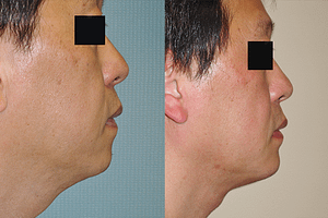 Chin Augmentation Before & After Photos