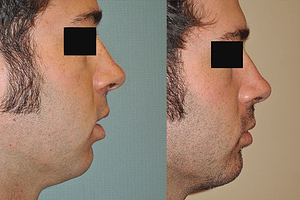 Chin Augmentation Before & After Photos