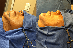 Chin Augmentation before and after photos