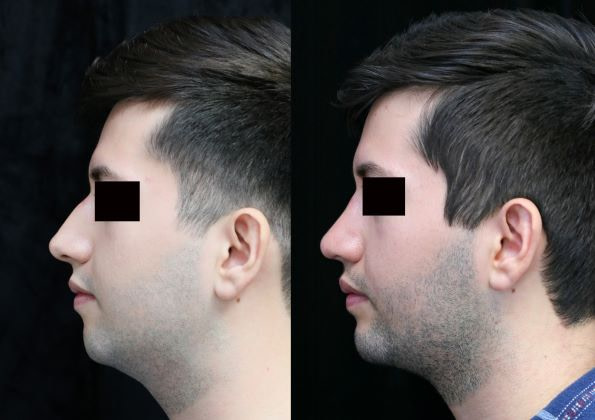 chin augmentation, rhinoplasty, neck liposuction left
