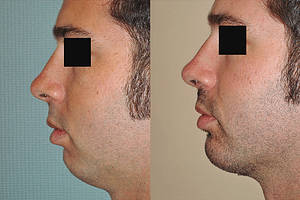 Chin Augmentation for Men Before & After Photos