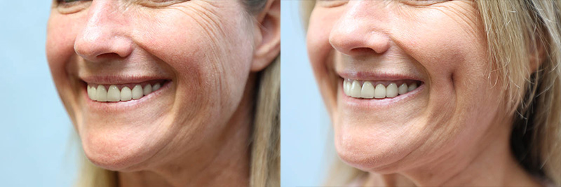 Dimpleplasty Before & After Photos