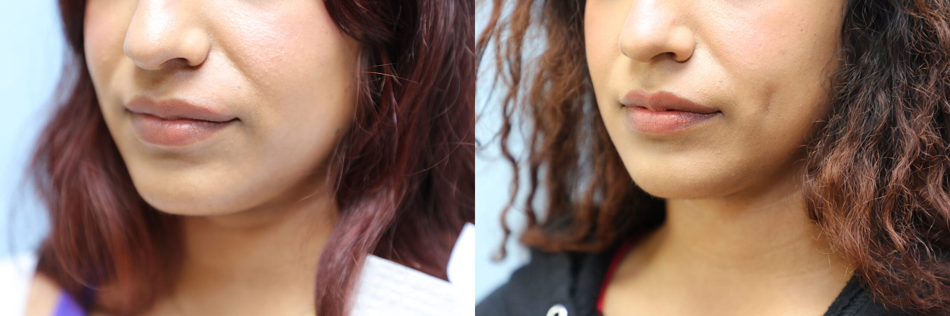 Dimpleplasty Before & After Photos