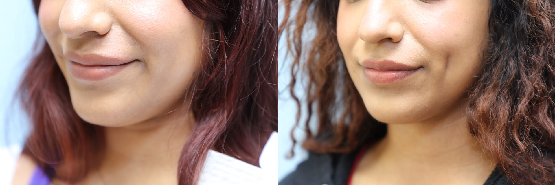 Dimpleplasty Before & After Photos